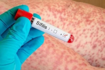 Foto de En pleno desfinanciamiento de la salud p�blica, se dispara la alerta sanitaria en Argentina por los casos de s�filis: crecieron un 71%